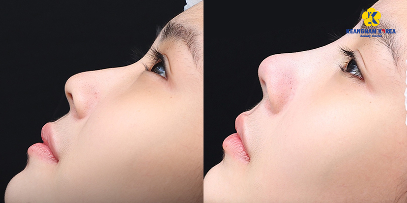 các loại sụn nâng mũi nhân tạo
