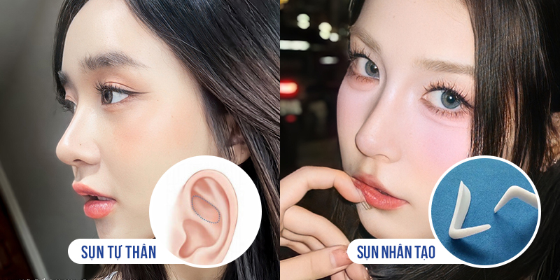 các loại sụn nhân tạo nâng mũi