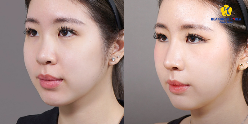 cac loai sun nang mui 3
