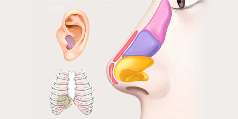 các loại sụn nâng mũi mới nhất hiện nay