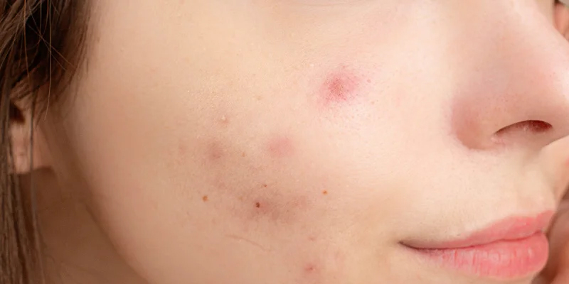 Cách chăm sóc da mụn tại Spa   