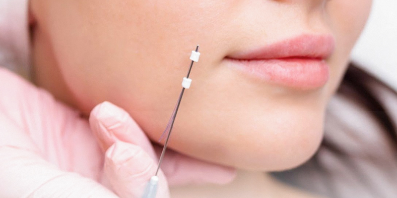 Căng chỉ collagen là gì