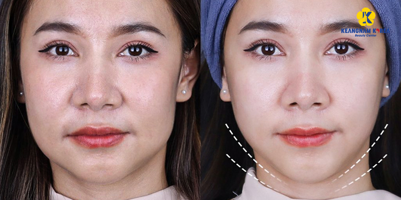 Căng chỉ collagen là gì