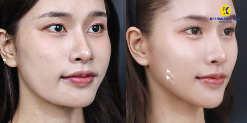 Căng chỉ collagen là gì