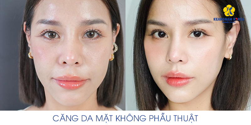 Căng da mặt ở đâu uy tín