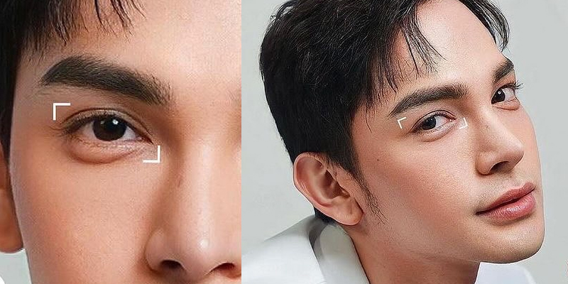 đại chỉ cắt mí mắt nam