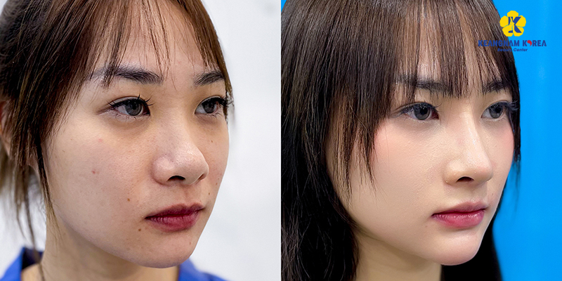 Làm mũi ở đâu đẹp, cao, uy tín