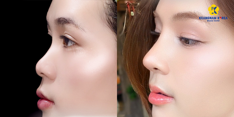 các kiểu nâng mũi siêu cấu trúc