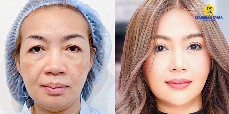 Xóa bọng mắt ở đâu đẹp?