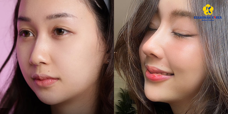 Rhinoplasty Implants: Cartilage Types, Cost, and Safety in 2026 3 Rhinoplasty Implants in vietnam