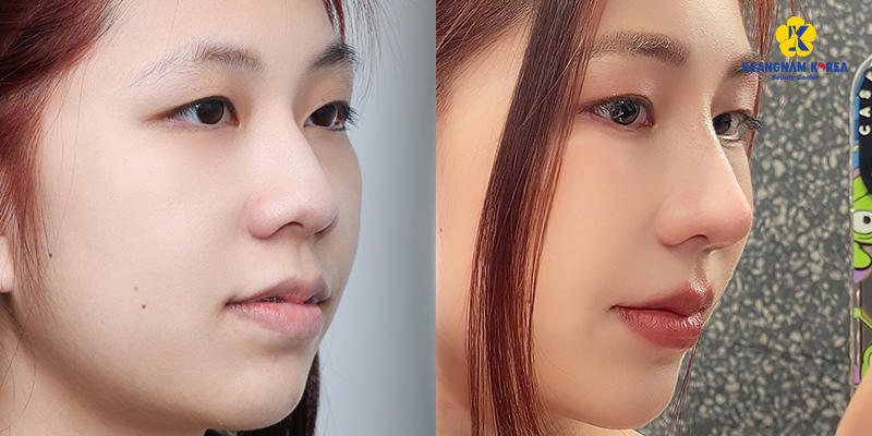 Rhinoplasty Implants: Cartilage Types, Cost, and Safety in 2026 4 Rhinoplasty Implants keangnam korea