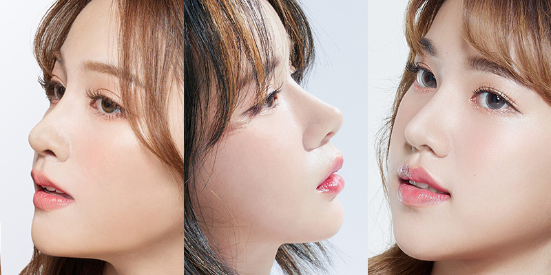 Rhinoplasty Implants: Cartilage Types, Cost, and Safety in 2026 1 Rhinoplasty Implants cost