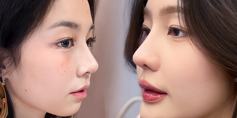 So sánh sụn Surgiform và sụn Softxil