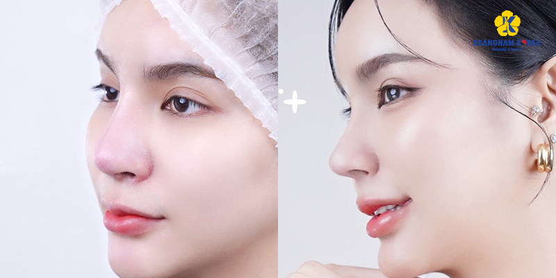 Sụn Nanoform là gì