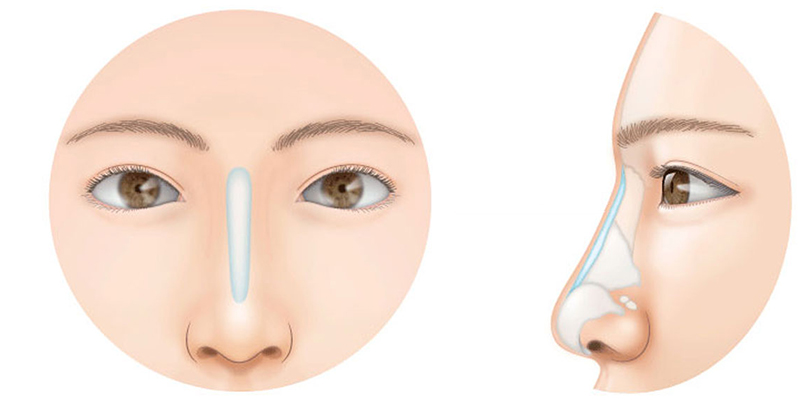 sụn nhân tạo có mấy loại