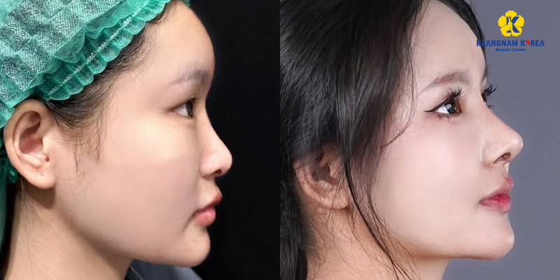 Sụn Surgiform là gì