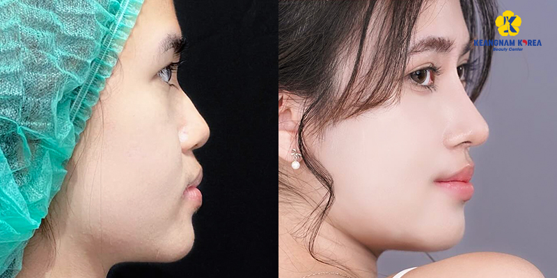 Sụn Surgiform là gì