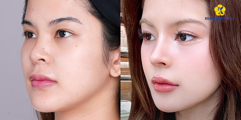 which type of rhinoplasty is best