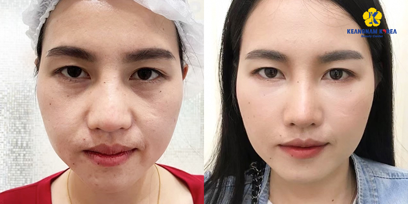 Bọng mắt có đẹp không? Có bọng mắt đẹp hay xấu?    3 có bọng mắt là đẹp hay xấu