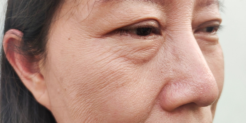 căng chỉ nâng da mặt
