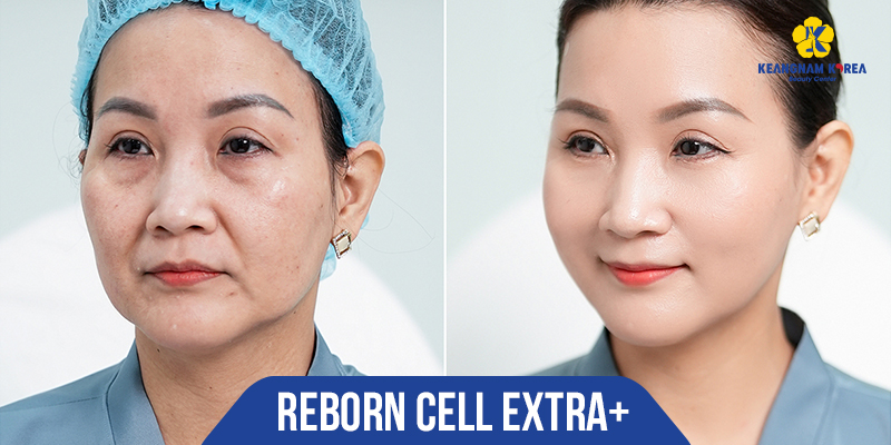 căng da reborn cell extra