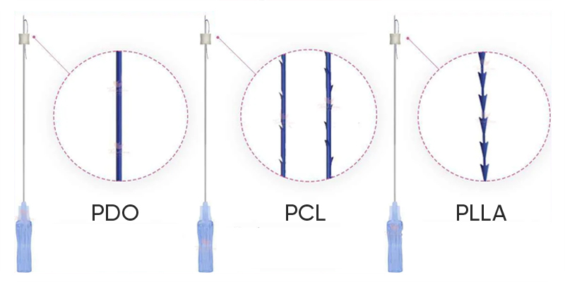 các loại chỉ nâng da mặt
