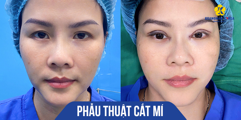 cách khắc phục mí mắt chảy xệ