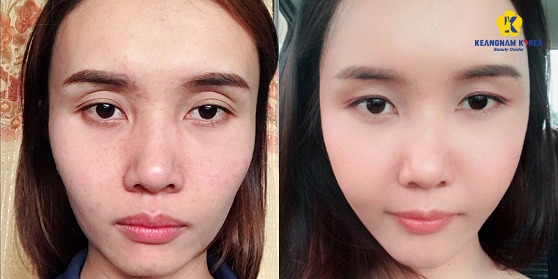 cách làm đầy hốc mắt tự nhiên