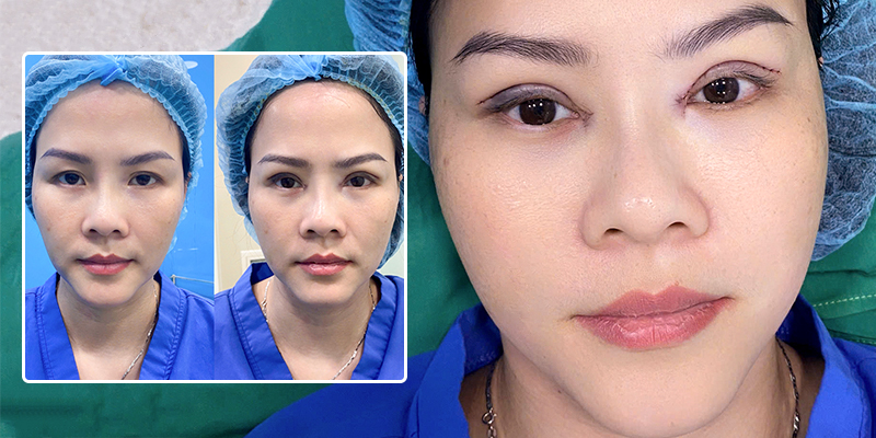 cách làm đầy hốc mắt tự nhiên
