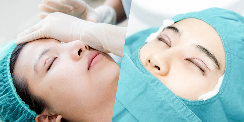 cách vệ sinh mắt sau khi cắt mí