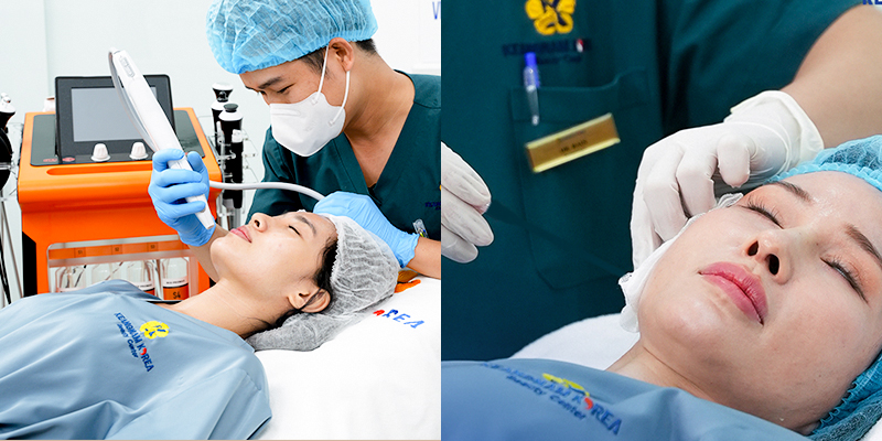 cấy chỉ collagen rãnh cười