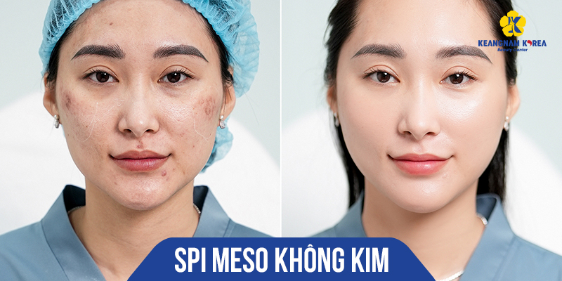căng da meso không kim