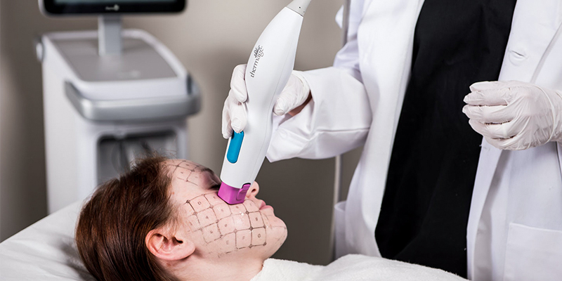 căng da mặt thermage