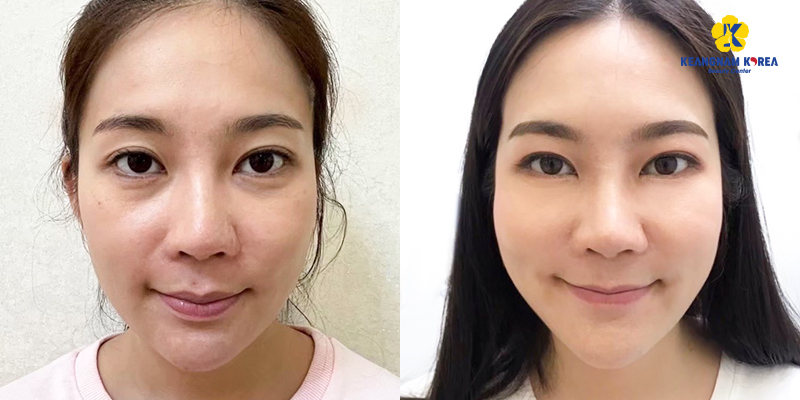Bọng mắt có đẹp không? Có bọng mắt đẹp hay xấu?    4 có bọng mắt đẹp hay xấu