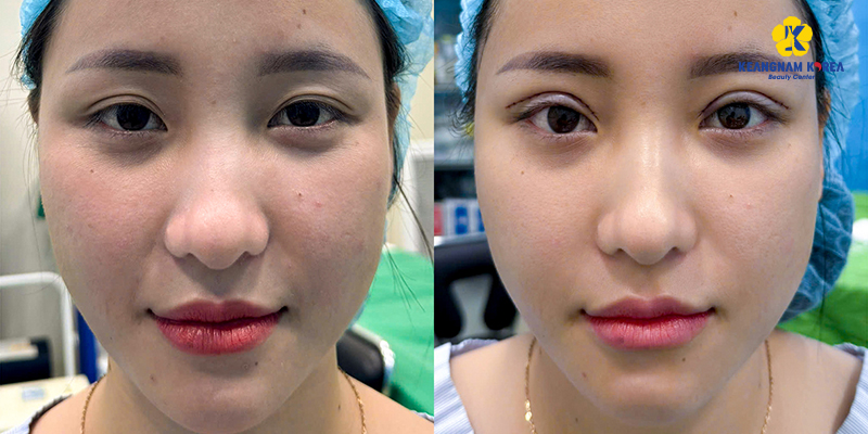 Phương pháp nâng đuôi mắt xệ không đau, trẻ trung sau một lần    6 nâng đuôi mắt xệ