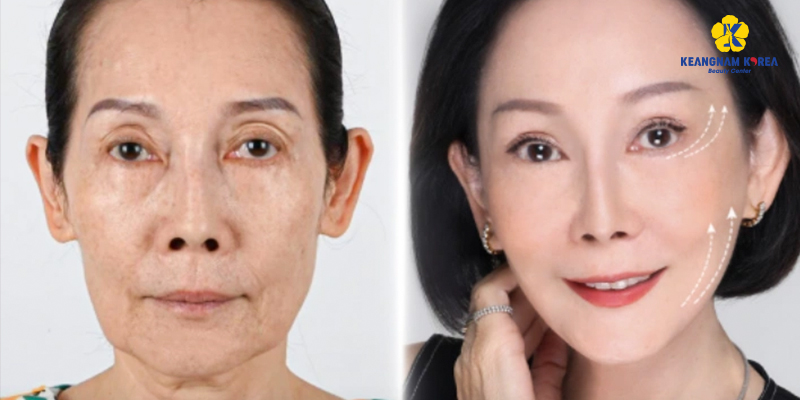 Hình ảnh trước và sau Phẫu thuật căng da mặt 
