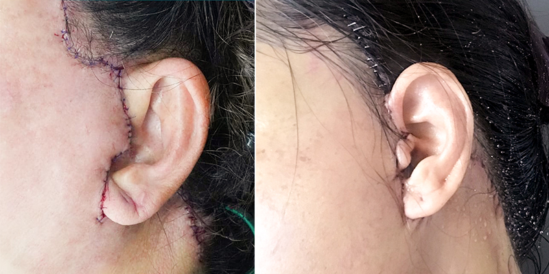 Phẫu thuật căng da mặt có nguy hiểm không