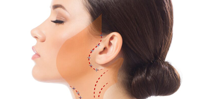 phẫu thuật nâng cơ mặt