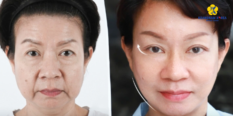 Phẫu thuật căng da mặt là gì?