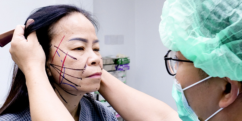 Lưu ý khi Phẫu thuật căng da mặt 
