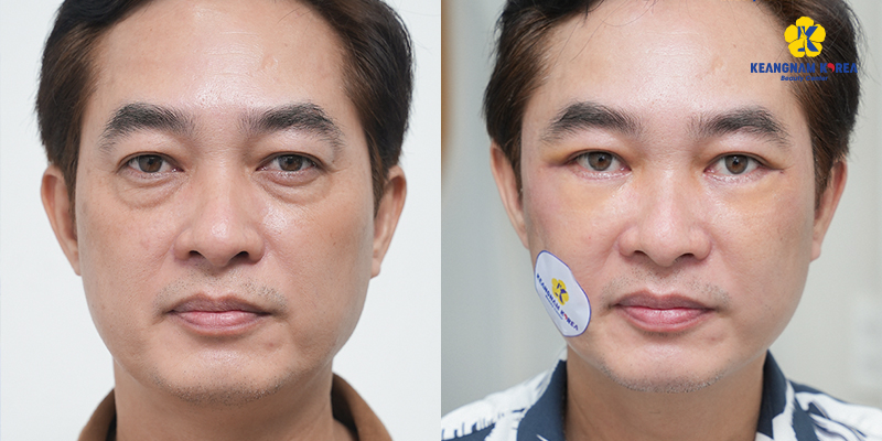 Cắt mí dưới có hết nhăn không