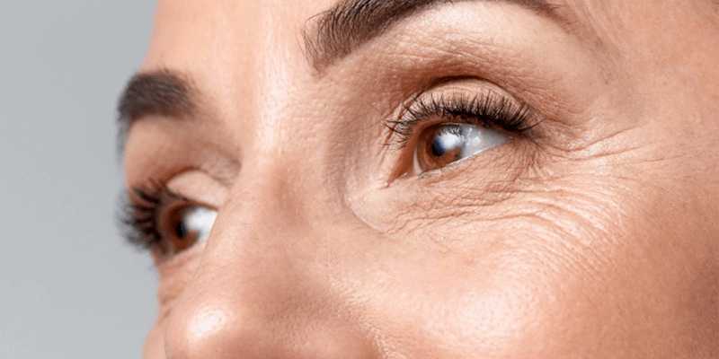 Cắt mí dưới có hết nhăn không