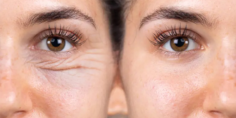 nếp nhăn ở mắt