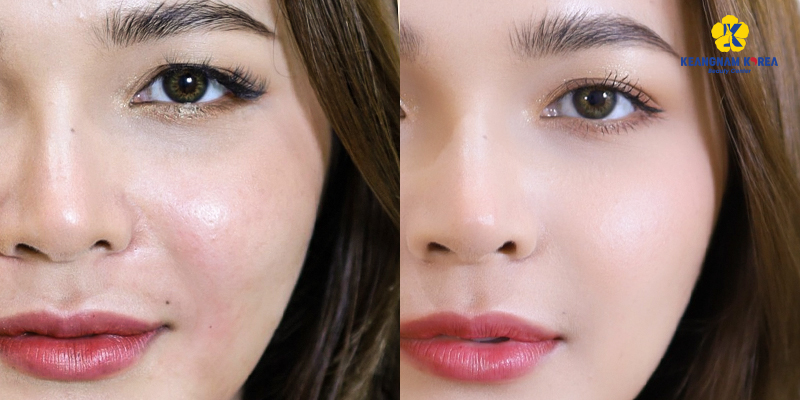 Tiêm Meso bao lâu tiêm lại?