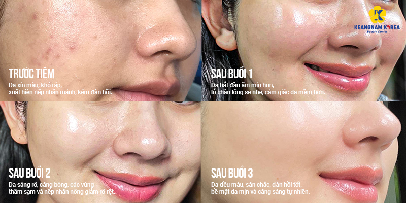 Tiêm Meso bao lâu tiêm lại?