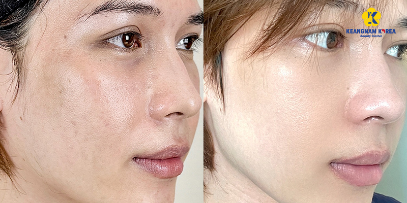 Tiêm Meso bao lâu tiêm lại?