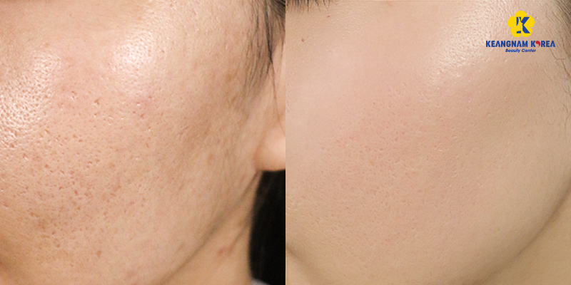 bắn laser da mặt có tác dụng gì