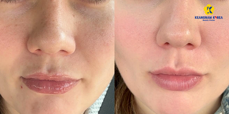 tác dụng của bắn laser da mặt là gì