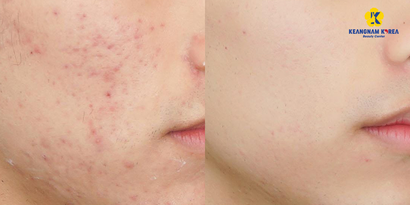 tác dụng của bắn laser mặt