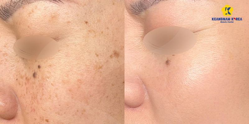 bắn laser mặt có tác dụng gì